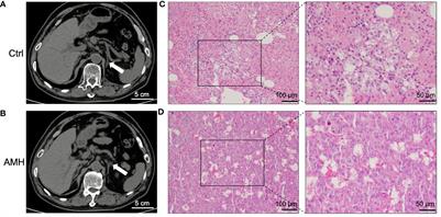 Clinical identification of expressed proteins in adrenal medullary hyperplasia detected with hypertension